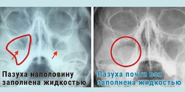 Рентген пазух носа: показання, фото при гаймориті, як зробити рентген гайморових пазух