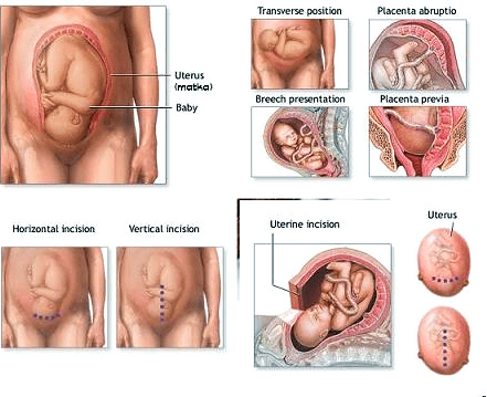 Плановий кесарів розтин: на якому терміні роблять, підготовка до планового КС