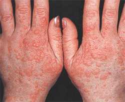 Холодова алергія: симптоми, класифікація, прояви холодової алергії, причини розвитку та методи лікування холодової алергії