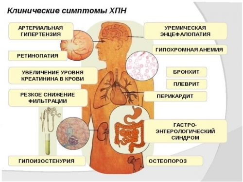 Симптоми хронічної ниркової недостатності: стадії і ознаки ниркової недостатності