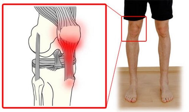 Запалення зв'язок колінного суглоба: причини, як виникає, симптоми і лікування