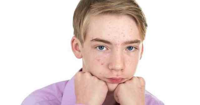 Вугрі та прищі у підлітків-хлопчиків: чим лікувати, кошти від підліткових прищів