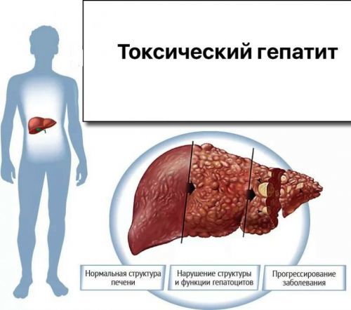 Гепатити: симптоми, класифікація гепатитів, причини, шляхи зараження, діагностика та лікування гепатиту  