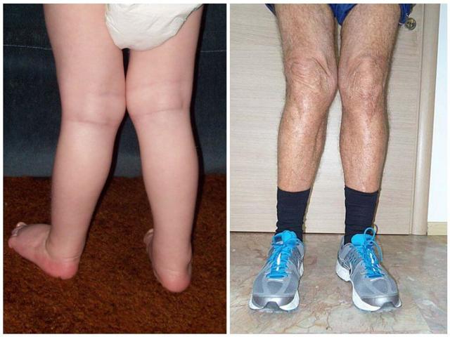 О-образні ноги, варусна деформація у дитини і дорослого: що носити, лікування