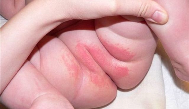 Алергія на памперси або підгузники: симптоми і лікування
