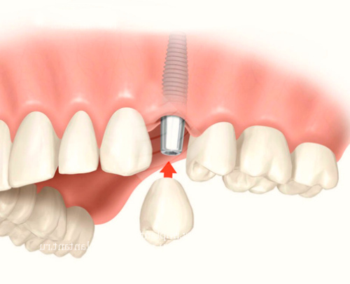 Зубні імплантати: плюси і мінуси, показання до установки