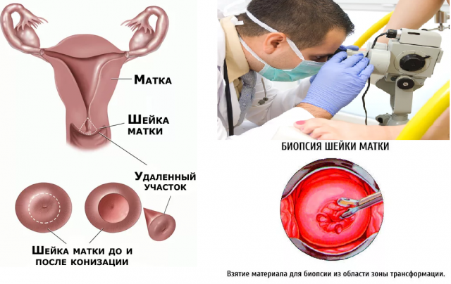 Біопсія шийки матки - що це таке, як проводиться біопсія, розшифровка