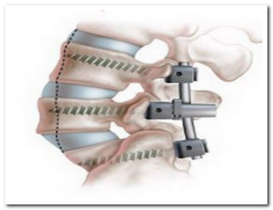 Спондилолистез шийного і попереково-крижового відділу хребта: що це, лікування