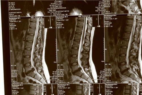 Комп'ютерна томографія хребта при міжхребцевої грижі: необхідність і шкода процедури 