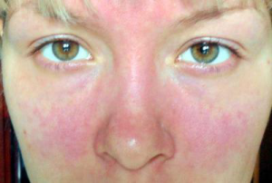 Алергія на косметику на обличчі, на очах: ​​симптоми, лікування, що робити