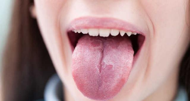 Географічний язик: причини виникнення у дорослого і дитини, лікування