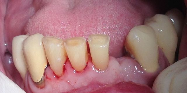 Підвищена стираемость зубів: провокуючі фактори, характерні прояви, лікувальні та профілактичні заходи