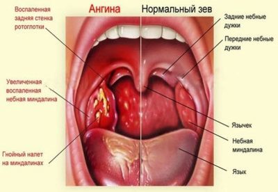 У дитини болить горло: як і чим швидко вилікувати в домашніх умовах