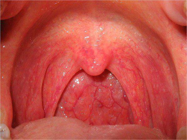 Туберкульоз гортані: причини, симптоми і лікування