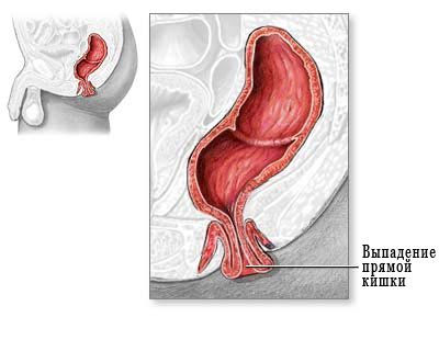 Ректальний пролапс: симптоми і лікування при випаданні прямої кишки у людини