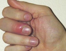Панариций на пальці руки, ноги: що це таке, характерні симптоми, методи лікування та профілактика захворювання