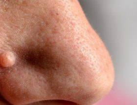 Наріст в носі у людини: види, причини і лікування