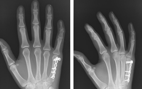 Перелом фаланги пальців кисті руки: симптоми, що робити, скільки носити гіпс