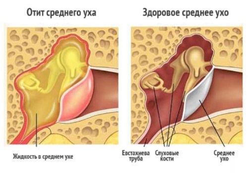 Що робити при болю у вусі і закладеності: лікування болю у вусі, біль у вусі як симптом, кошти від вушної болю