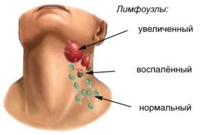 Вказує чи запалення лімфовузлів горла на вич?