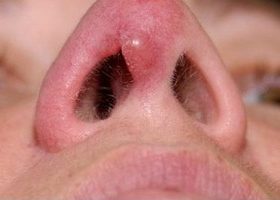 Доброякісні пухлини порожнини носа: що це таке, види новоутворень, основні симптоми і методи лікування