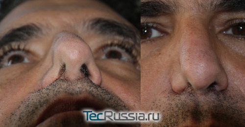 Великий ніс - пластика носа, операція, ускладнення після ринопластики, підготовка