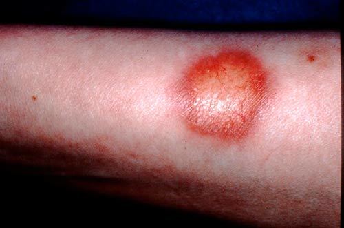 Ліпоїдний некробіоз шкіри: причини, симптоми, лікування, фото до і після