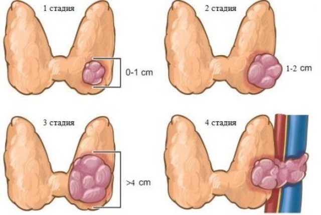 Папілярний рак щитовидки - причини, лікування і операція, прогноз