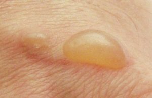 Про яку хворобу говорить висипання бульбашок на шкірі?