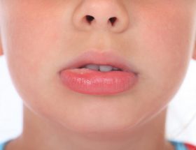 Фурункул на губі: причини появи і ефективні методи лікування чірья