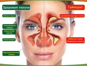 Кров з носа при гаймориті: причини і лікування виділень