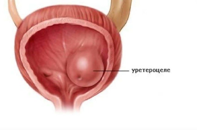 Уретероцеле сечового міхура: симптоми і лікування у жінок і дітей