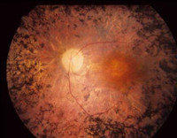 Ретиніт - симптоми, лікування, причини інфекційно-запального, пігментного ретиніт
