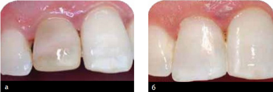 Ендоотбеліваніе зубів - внутрішньокоронкове відбілювання: як працює і які використовуються препарати