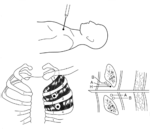 Плевральна пункція: показання, техніка проведення при пневмотораксі і гидротораксе