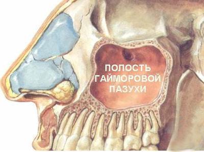 Лікування гаймориту в домашніх умовах у дорослих швидко