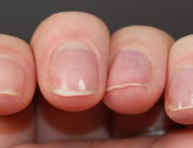 Чому шаруються нігті на руках і ногах: причини ламкості