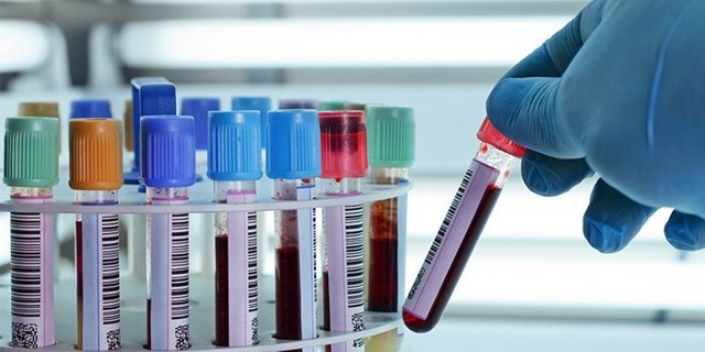 Аналіз крові на креатинін: що це таке і які нормальні значення, як підготуватися