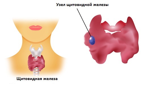 Кістозно-солідну освіту щитовидної залози: симптоми і лікування