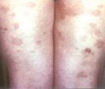 Алергічний васкуліт - що це за хвороба, симптоми, лікування у дітей та дорослих