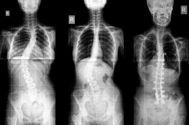 Рентген хребта: що показує, підготовка, як часто можна робити рентген