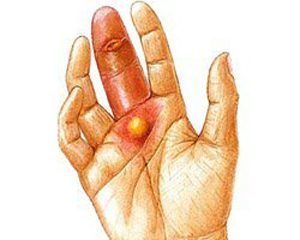 Панариций на пальці руки, ноги, форми панарицію, симптоми і лікування панарицію 