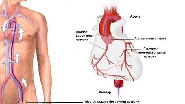 Коронарографія судин серця: що це таке, як роблять, наслідки