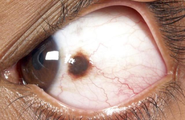 Чорна точка в оці на рогівці, пересувається з поглядом: лікування сліпих плям