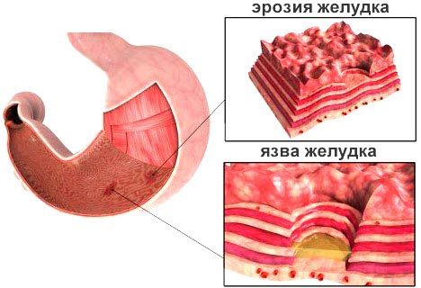 Гіпертрофічний гастрит шлунка: що це таке, симптоми, лікування