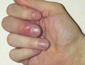 Задирки на пальцях: причини появи, найефективніші методи лікування