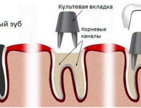 Зубні вкладки в стоматології: що це таке, види, матеріали, процес установки