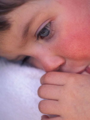 Скарлатина у дітей: відмітні ознаки, інкубаційний період і методи лікування захворювання з докладними фото