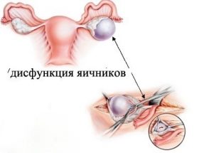 Дисфункція яєчників: причини і симптоми, вагітність і вікові зміни, лікування та профілактика