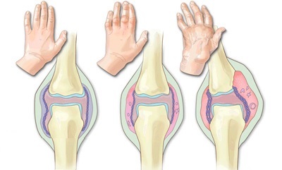 Як вилікувати ревматоїдний артрит і позбутися від болю в суглобах